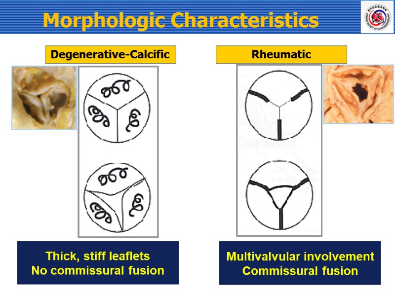 Morphologic Characteristics  Degenerative-Calcific Rheumatic Thick, stiff leaflets No commissural fusion Multivalvular involvement Commissural